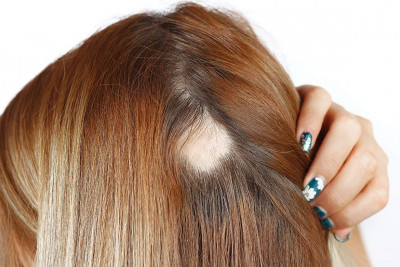 Rambut Rontok hingga Pitak, Awas Penyakit Alopecia Areata